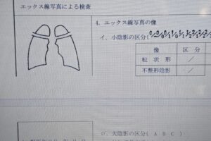 石綿肺の切り捨て